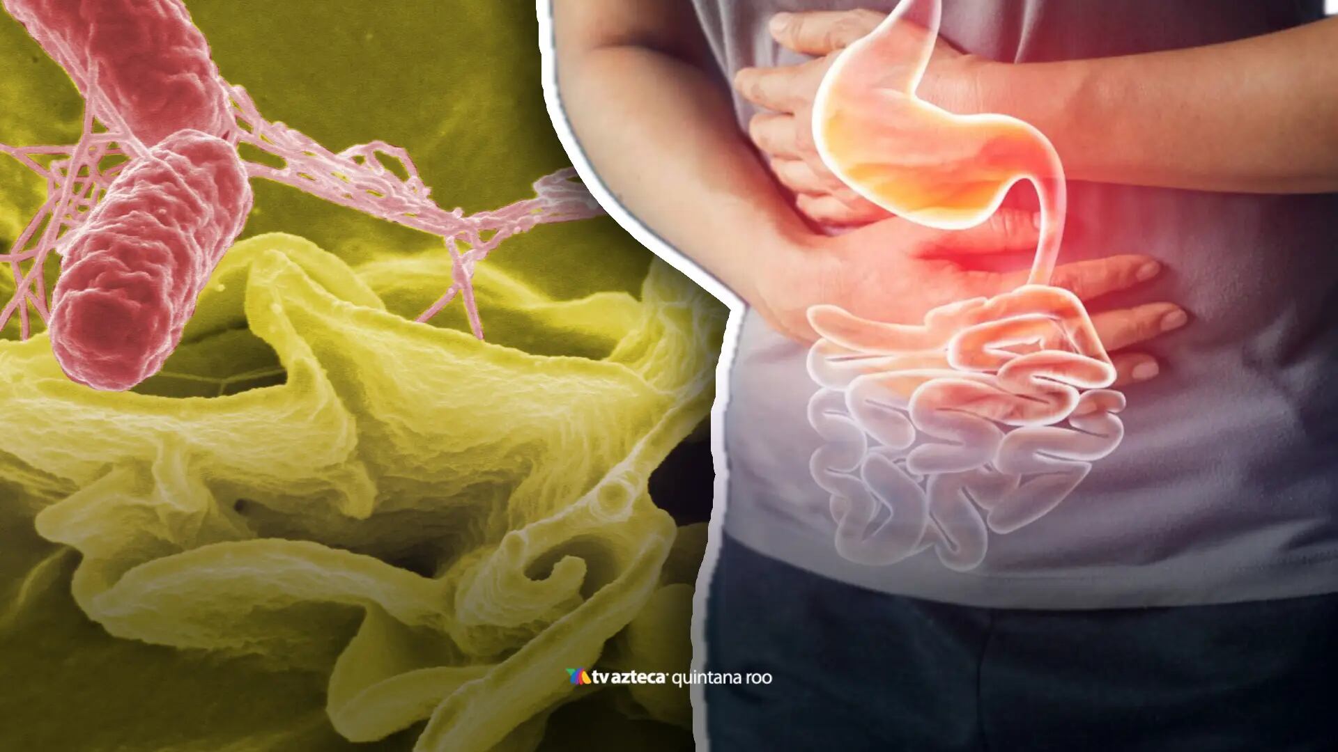 ¿Cuáles son los síntomas de la salmonelosis? Así puedes identificar la infección por salmonela a tiempo